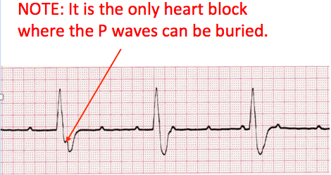 heart block ecg image 110