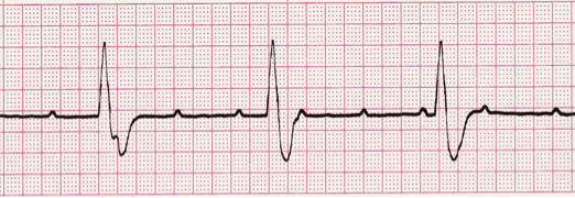 third degree av block ecg image 111