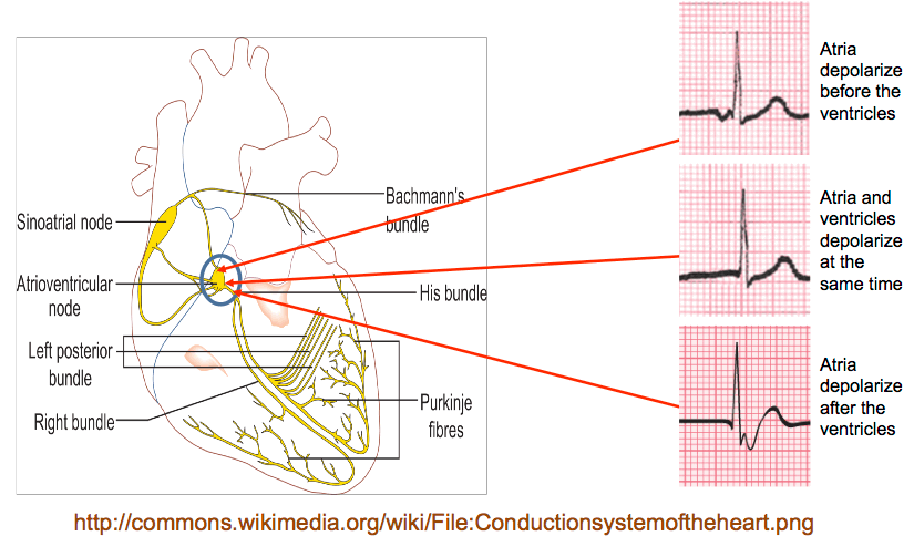 junctional ecg image 2