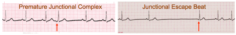 junctional escape beat ecg image 3