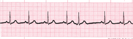 “ecg