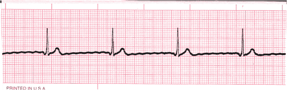 junctional escape rhythm ecg strip