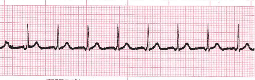 atropine on junctional escape rhythm