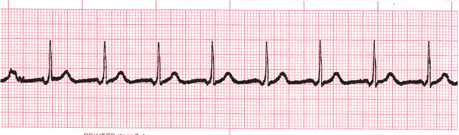 accelerated junctional rhythm ecg image 11