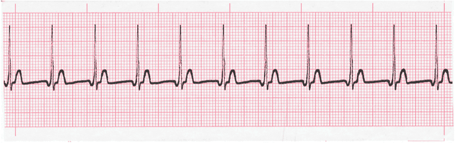 junctional tachycardia tracing