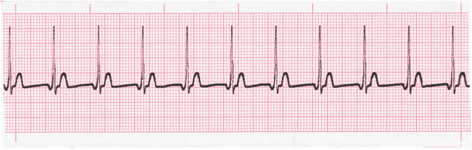 junctional tachycardia tracing #2