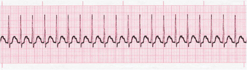 Supraventricular Tachycardia Ekg Lesson Module 31