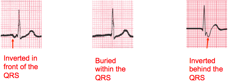 junctional ecg retrodgrade p wave ekg