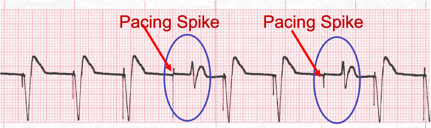 pacemaker ecg image 102b