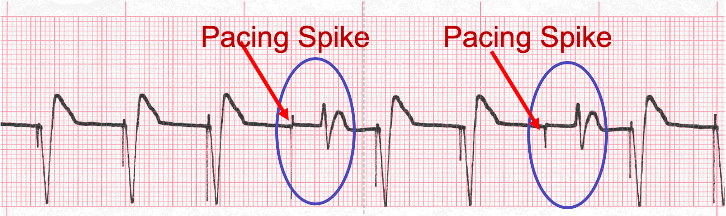 Pacemaker Rhythm Ecgs