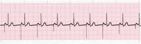 pacemaker ecg image 103