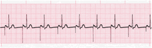 Atrial Pacemaker Rhythm ECG Interpretation #317