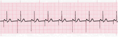 pacemaker ecg image 104