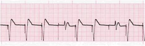 ventricular paced rhythm with failure to capture