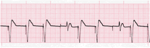 pacemaker ecg image 110