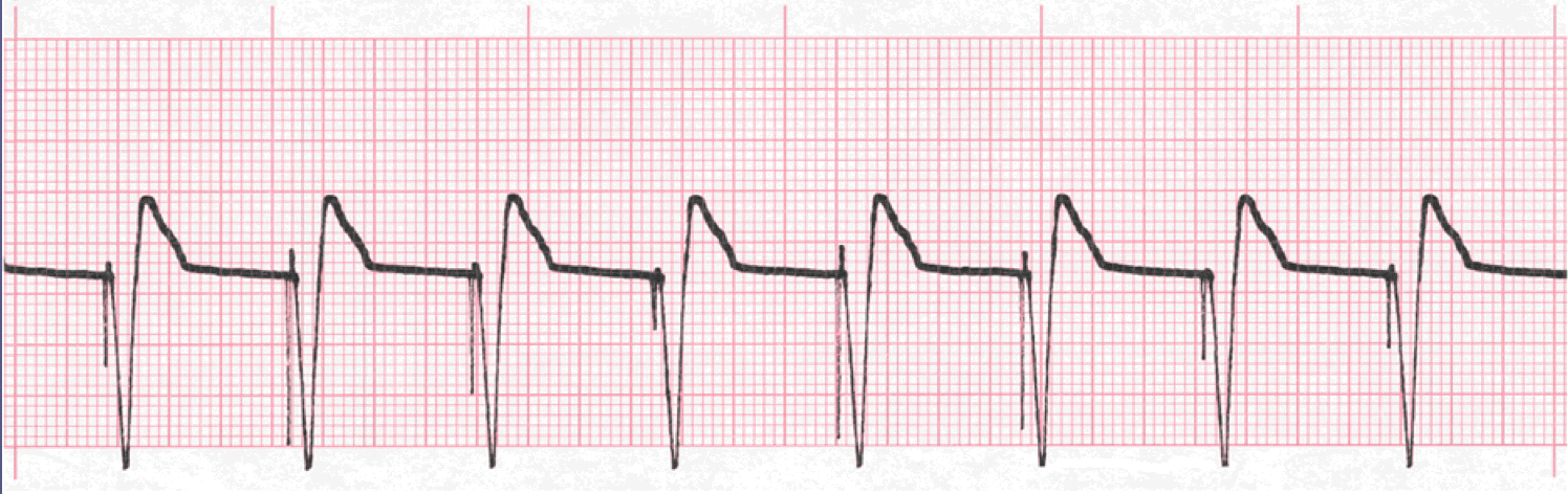 image P118 ventricular pace