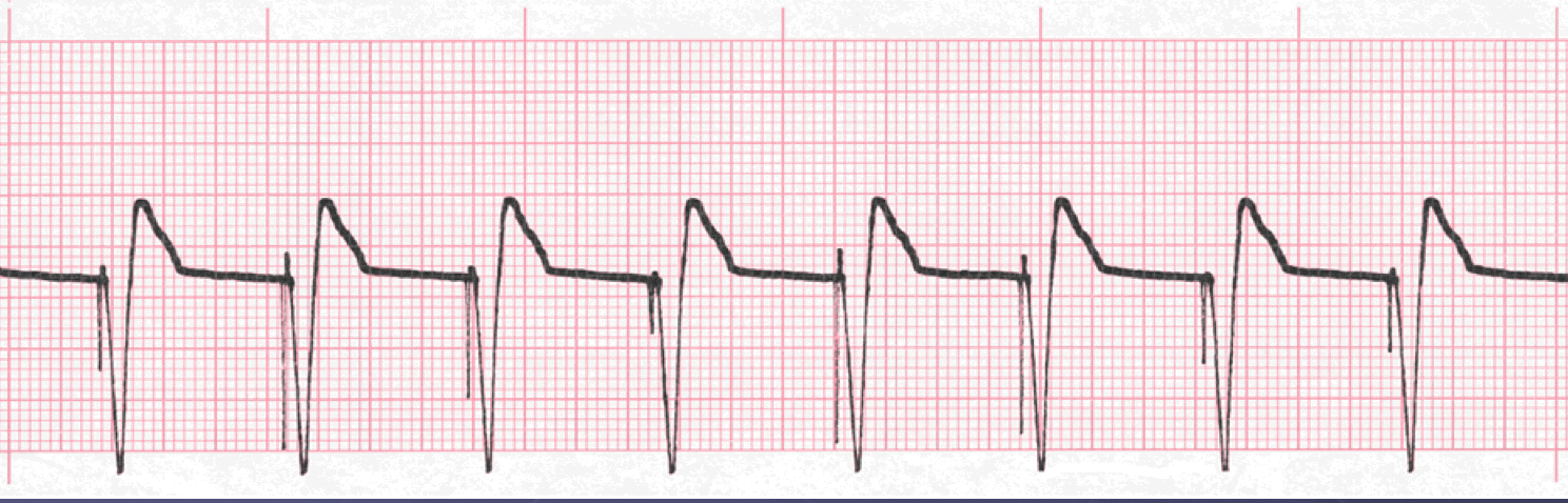 pacemaker ecg image ventricular