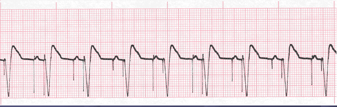 atrioventricular tracing question