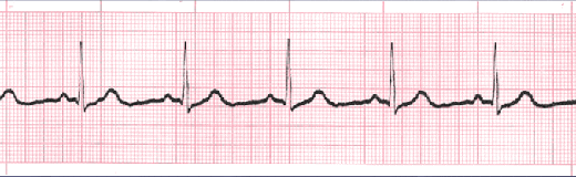 sinus bradycardia tracing