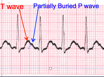 sinus tachycardia tracing