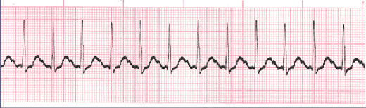 sinus tachycardia tracing