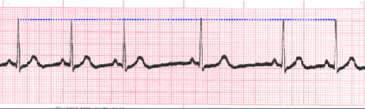 sinus arrhythmia tracing