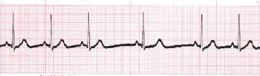 sinus dysrhythmia tracing