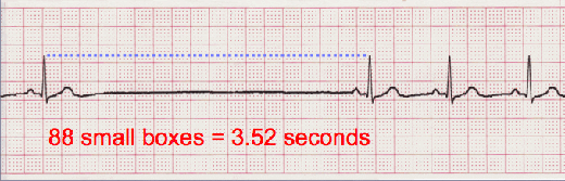 sinus arrest ECG tracing