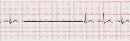 ecg sinus arrest tracing