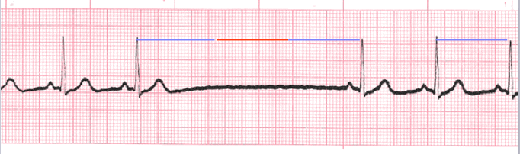 sinus exit block ECG tracing