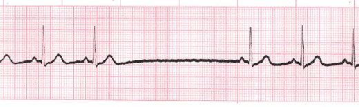 sinus arrest vs sinus block tracing