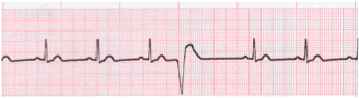 ventricular ecg image 101