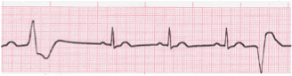 ventricular ecg image 102