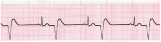 ventricular ecg image