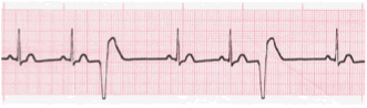 ventricular ecg image 2