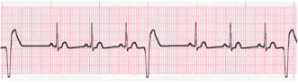 ventricular ecg image 3