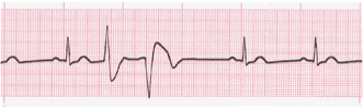 ventricular ecg image 4