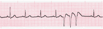 ventricular ecg image 5