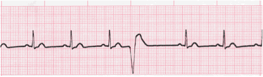 pvc ecg image 6