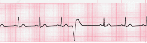 pvc on ecg strip 109