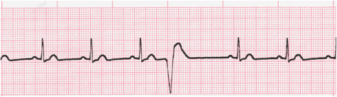 Premature Ventricular Complexes Pvc S Ecg Interpretation