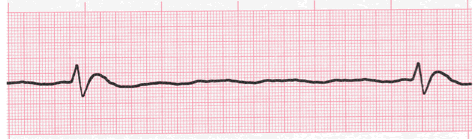 agonal ecg rhythm image 111