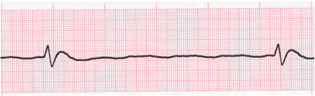 agonal rhythm ecg image 112