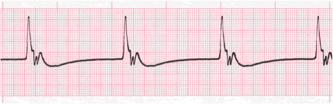 idioventricular rhythm ecg image 113