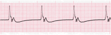 idioventricular rhythm ecg image 114b