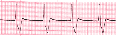 ventricular ecg image 115