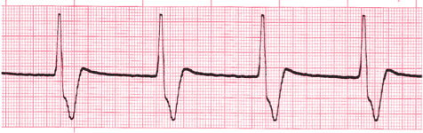 ventricular ecg image 116