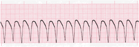 ventricular tachycardia tracing