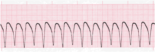 ventricular tachycardia tracing #2