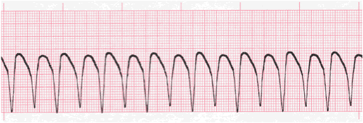 ventricular tachycardia ecg